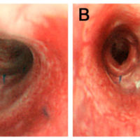 3D Bioprinted Artificial Trachea with Epithelial Cells and Chondrogenic-Differentiated Bone Marrow-Derived Mesenchymal Stem Cells 3D Bioprinted Artificial Trachea with Epithelial Cells and Chondrogenic-Differentiated Bone Marrow-Derived Mesenchymal Stem Cells