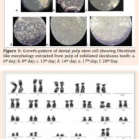 Exfoliated Deciduous Tooth as the Source of Stem Cells: A Technique for Proliferation and Chromosome Analysis In Vitro Exfoliated Deciduous Tooth as the Source of Stem Cells: A Technique for Proliferation and Chromosome Analysis In Vitro