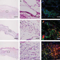 Stem cells from human exfoliated deciduous teeth (SHED) enhance
wound healing and the possibility of novel cell therapy Stem cells from human exfoliated deciduous teeth (SHED) enhance wound healing and the possibility of novel cell therapy